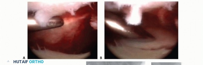Illustration 6 for Arthroscopic Fixation: Effectively Treating Radial Styloid Fragments