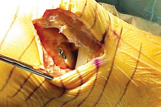 صورة طبية: جراحة استبدال مفصل الركبة الجزئي (UKA): تجنب الأخطاء والاستفادة القصوى في صنعاء مع الأستاذ الدكتور محمد هطيف