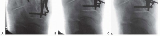 Illustration 20 for Fixation of Lisfranc Injuries: Essential Open Reduction Guide