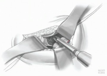 صورة طبية: النهج الأمامي لاستبدال مفصل الورك الكلي: ثورة في جراحة الورك مع الأستاذ الدكتور محمد هطيف في صنعاء