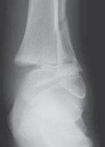 Illustration 11 for Pediatric Ankle Fractures: Management to Prevent Long-Term Issues
