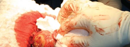 Illustration 51 for Metal on Metal Resurfacing: Enhanced Posterior Soft Tissue Repair