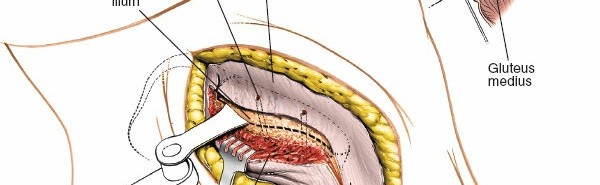 Illustration 26 for Pelvis & Acetabulum Approaches: Unlocking the Posterior Superior Iliac
