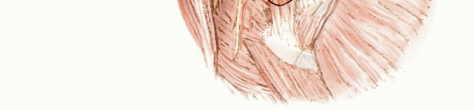Illustration 5 for Limb-Sparing Resections Around the Shoulder: Optimizing Outcomes