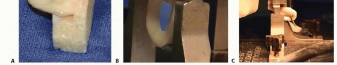 Illustration 10 for Symptomatic Knee? Meniscal Transplant for Anterior & Posterior Horns