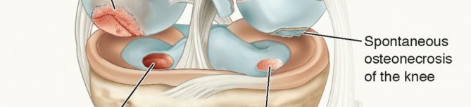 Illustration 2 for Dissecans of the Knee: What's the Difference – OCD vs. AVN?