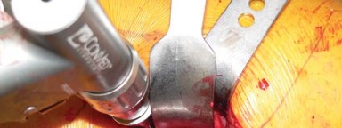 Illustration 42 for Exploring the Ambulatory Surgical Setting for Total Hip Replacement