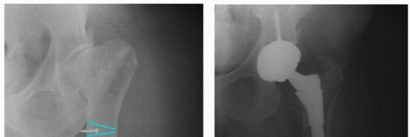 Illustration 9 for Overcoming Proximal Femoral Deformity in THA: Key Strategies