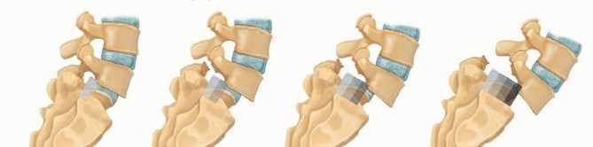 Illustration 2 for Mastering High-Grade Spondylolisthesis: Posterolateral and Interbody Fusion