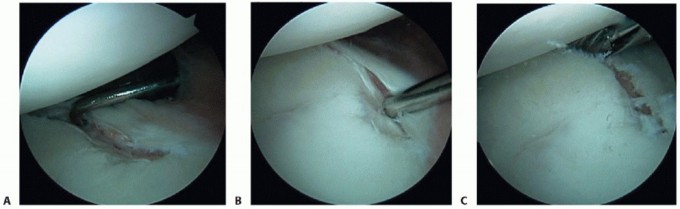 Illustration 4 for Finally Treat Recurrent Posterior Instability of the Shoulder