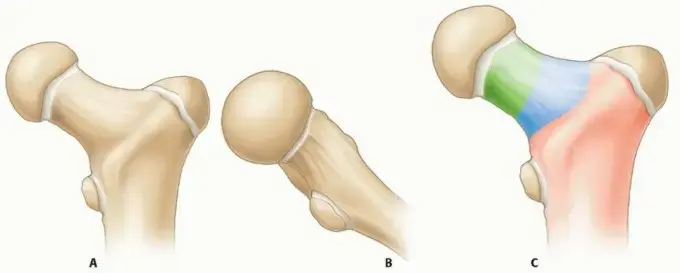 كسر مفصل الورك لدى الأطفال: دليلك الشامل للعلاج والتعافي مع الأستاذ الدكتور محمد هطيف