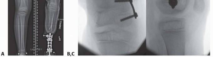 Illustration 6 for Optimizing Growth to Correct Pediatric Limb Deformities