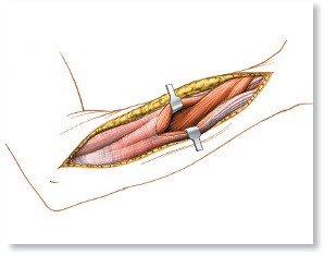 Illustration of third of the radius - Dr. Mohammed Hutaif