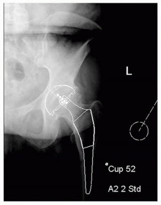 The Tapered Stem: Your Guide to Durable Cementless Hip Fixation