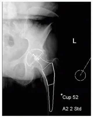 ساق الفخذ المدبب: دليل شامل لتثبيت مفصل الورك اللاأسمنتي طويل الأمد مع الأستاذ الدكتور محمد هطيف في صنعاء