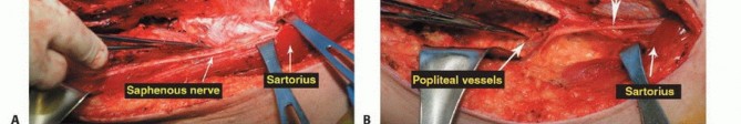 Illustration 33 for Advanced Distal Femoral Resections: Limb-Sparing Outcomes & Techniques