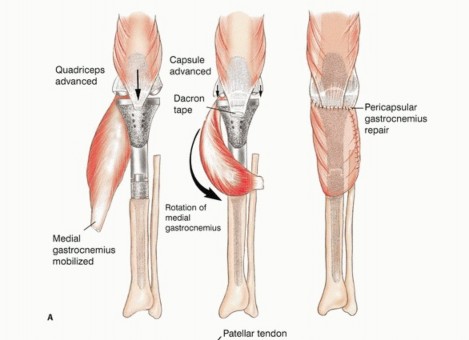 Illustration 38 for Tackling Complex Tumors of the Proximal Tibia: Limb-Sparing Solutions