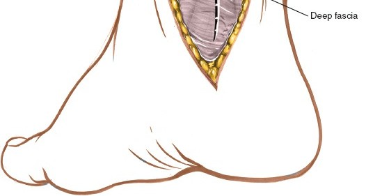 Illustration 20 for Step-by-Step Medial Side of the Ankle Approach Guide