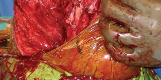 Illustration 38 for Hinged Total Knee: The Salvage Solution for Challenging Cases