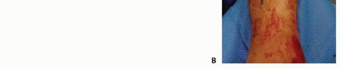 Illustration 39 for Tibia External Fixation: See How Pins Are Placed for Healing