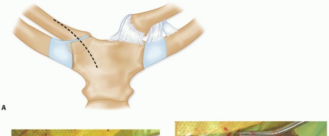 Illustration 17 for Optimizing SC Dislocation Repair After Medial Clavicle Resection