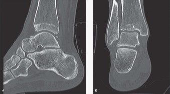 Illustration 2 for Ballet Dancer's Ankle: Is Total Ankle Arthroplasty the Answer?