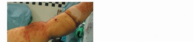 Illustration 61 for Repairing Distal Femur Fractures: Open Reduction & Internal Fixation