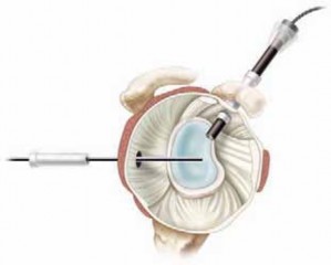 Illustration 25 for Capsular Releases for Loss of Motion: Restore Your Shoulder