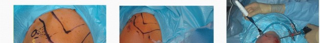 Illustration 10 for Stiff Shoulder? Discover Arthroscopic Capsular Release Solutions