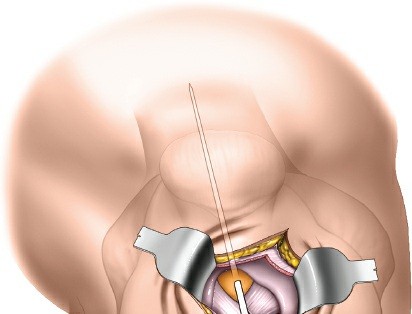 Illustration 83 for Optimal Femoral Approaches: Mastering the Lateral Intermuscular Septum