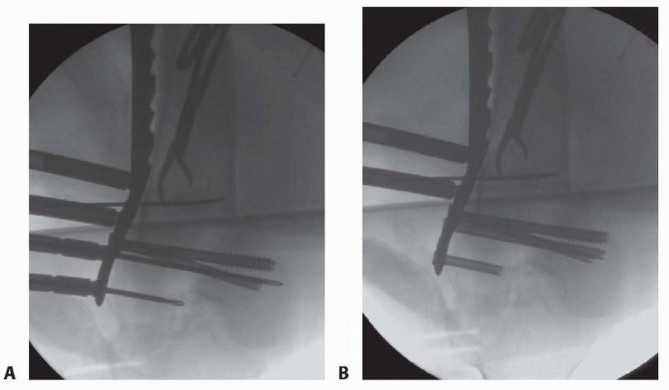Illustration 52 for Repairing Distal Femur Fractures: Open Reduction & Internal Fixation