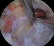 Relieve Nerve Entrapment Pain with Arthroscopic Release