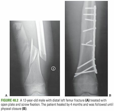 Illustration 5 for Master Pediatric Femoral Shaft & Knee Fractures: Interactive Module