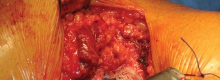 Illustration 38 for Kinectiv® Stem: Modular Necks for Primary THA Success