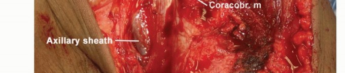 Illustration 25 for Limb-Sparing Resections Around the Shoulder: Optimizing Outcomes