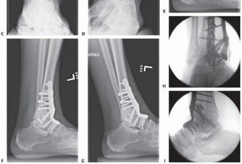 Illustration 32 for Optimize Pain Management with Proximal Ring Block for Ankle Arthrodesis