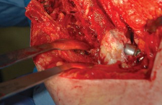 Illustration 76 for Femoral Stem Revision: Posterior Approach for Better Outcomes