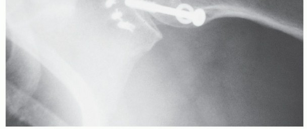 Illustration 34 for Bankart Repair & Inferior Capsular Shift: Solving Shoulder Instability