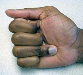 صورة طبية: دليل الأستاذ الدكتور محمد هطيف الشامل لأمراض وإصابات اليد والمعصم في صنعاء