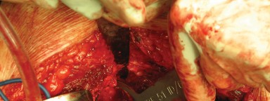 Illustration 54 for Figure Hip Resurfacing: Who Benefits and Who Should Avoid It?