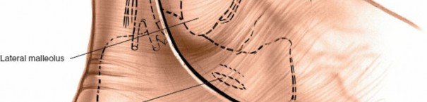 Illustration 2 for Mastering the Lateral Approach to the Posterior Talocalcaneal Joint