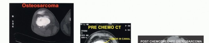 Illustration 21 for Advanced Distal Femoral Resections: Limb-Sparing Outcomes & Techniques
