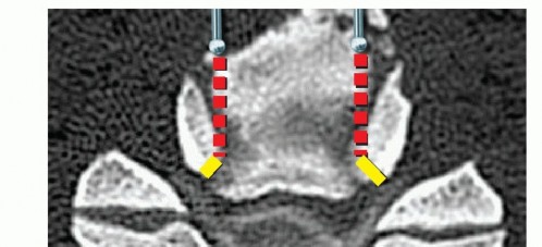 Illustration 8 for Stop Numbness & Instability: Corpectomy and Fusion Guide