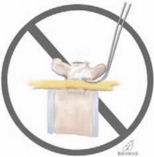 Illustration 17 for Optimizing Instrumentation for Neuromuscular Scoliosis