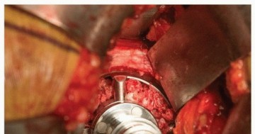 Illustration 6 for Mastering The Uncemented Socket: Ensure Lasting Hip Fixation