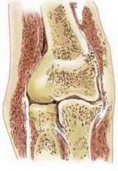 Illustration of direct lateral portal - Dr. Mohammed Hutaif