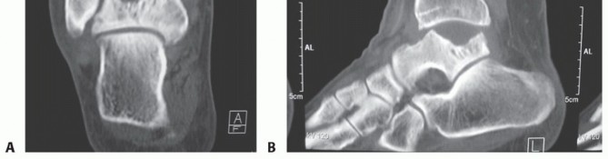 Illustration 10 for Unlock Stability: Medullary Nail Fixation for Tibiotalocalcaneal Arthrodesis