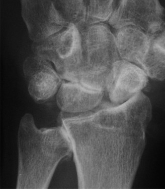 Illustration 12 for Christine M Kleinert Discussion: Solving Difficult Wrist Fractures