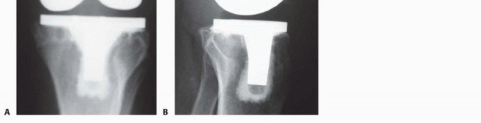 Illustration 8 for Femoral Bone Loss: Metal Augments for Revision Knee Success
