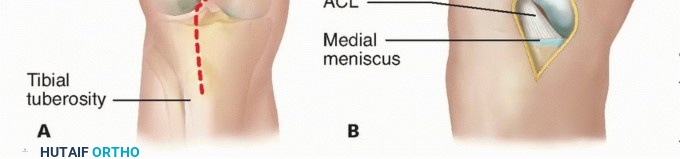 Illustration 20 for Treating Tibial Spine Fractures: Arthroscopy or Open Reduction?